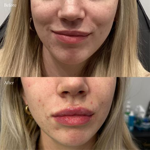 Lip Filler
